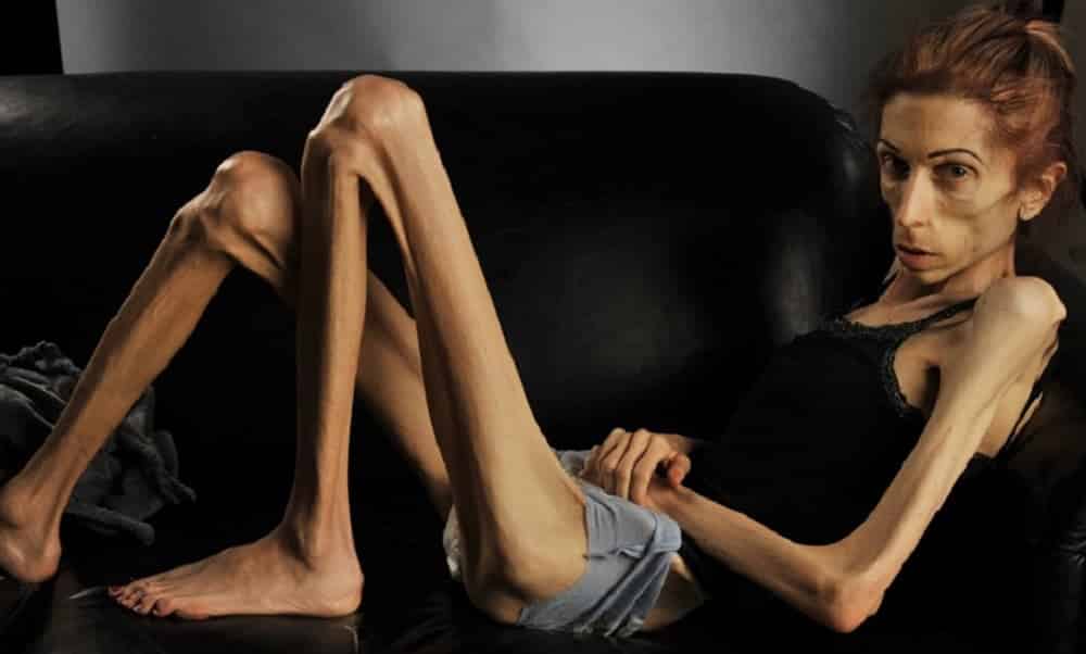 Acha que anorexia é só um transtorno bobo? 