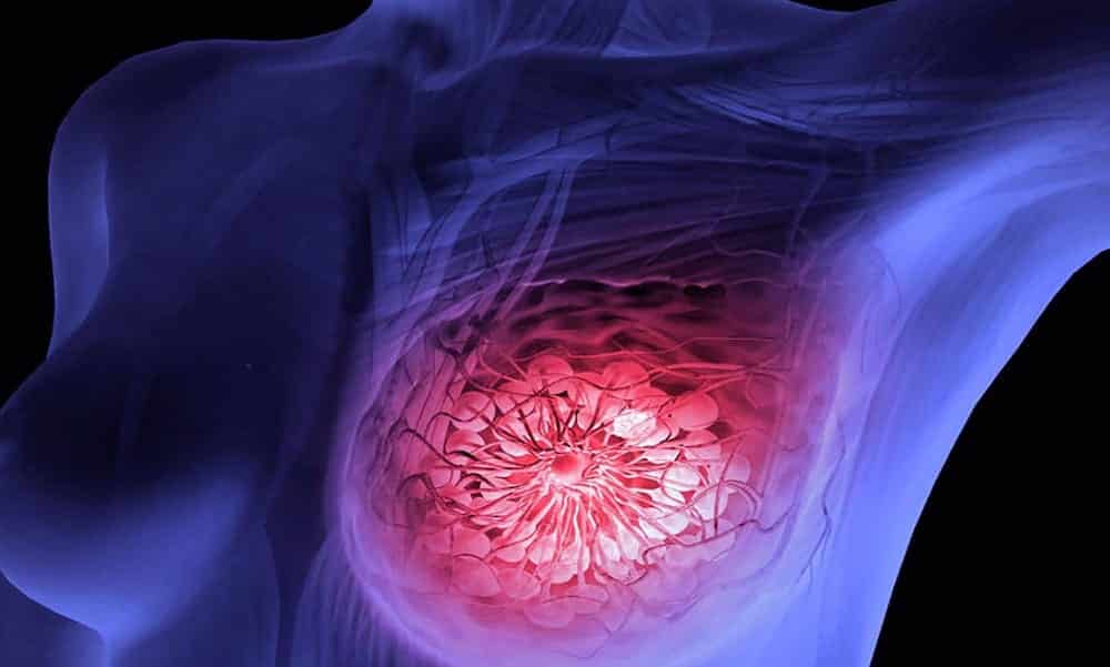 8 sintomas de câncer de mama que vão muito além do nódulo