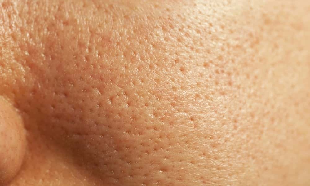 7 receitinhas caseiras certeiras contra poros dilatados