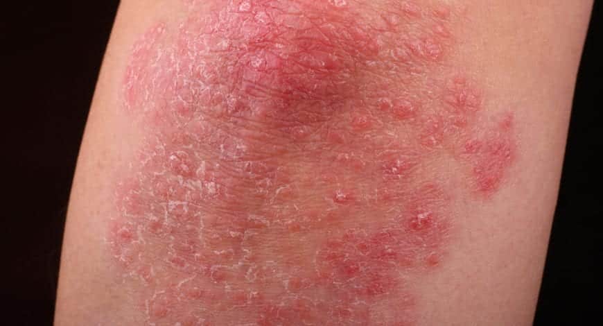 7 causas mais comuns de pele seca ou ressecada