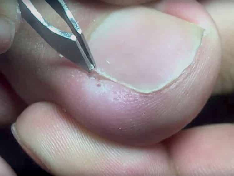 Quais são os sintomas, causas e tratamento de uma unha encravada!