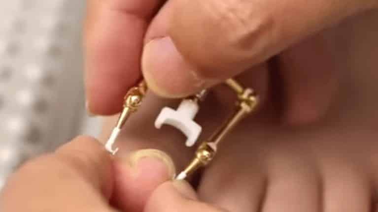 Quais são os sintomas, causas e tratamento de uma unha encravada!