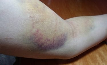 Roxos pelo corpo, quando pode ser sinal de doença?