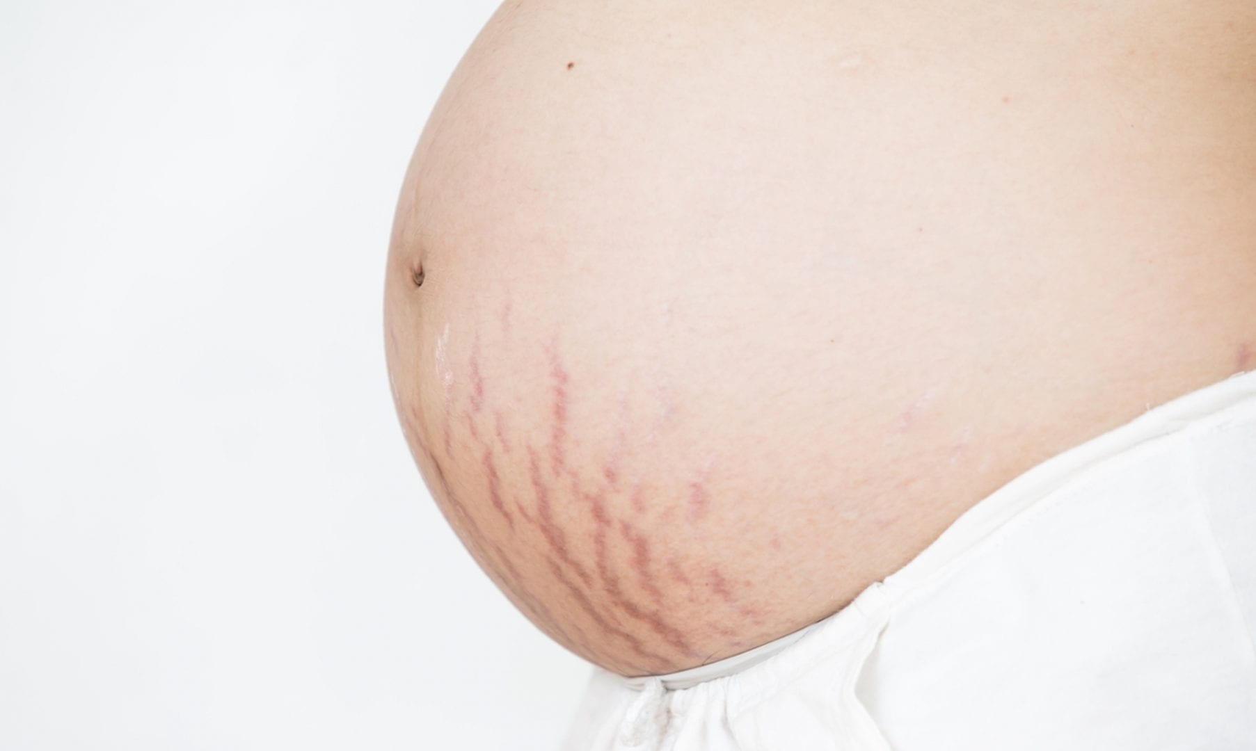 Estrias na gravidez - O que são, por que surgem e como evitá-las