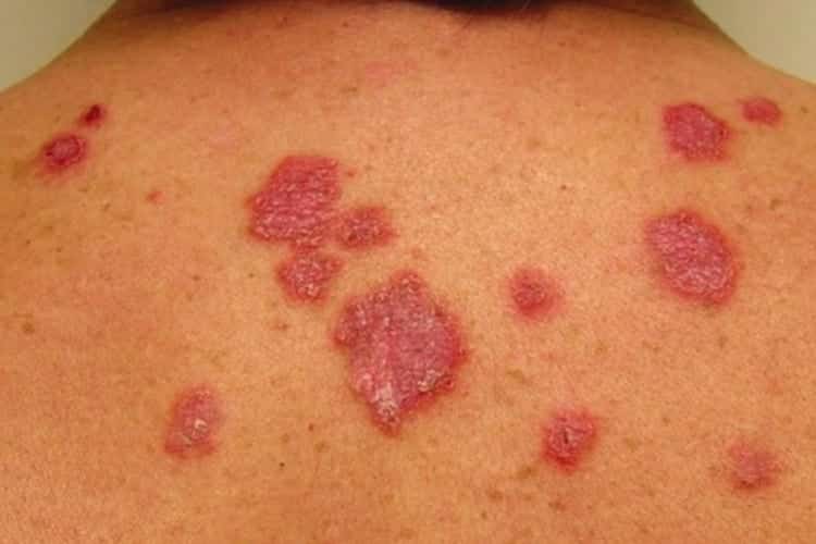 Confira agora as 10 doenças que podem causar mancha vermelha na pele