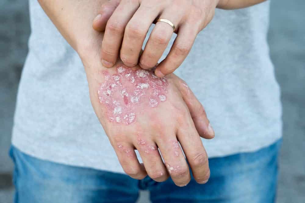 Problemas de pele - 7 doenças que causam mancha na pele