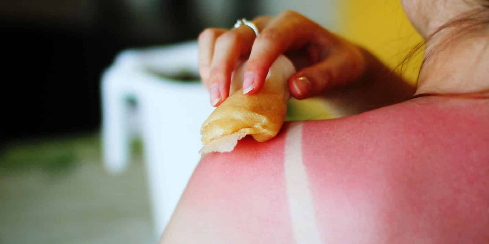 Queimadura de sol Consequências na pele, como evitar e