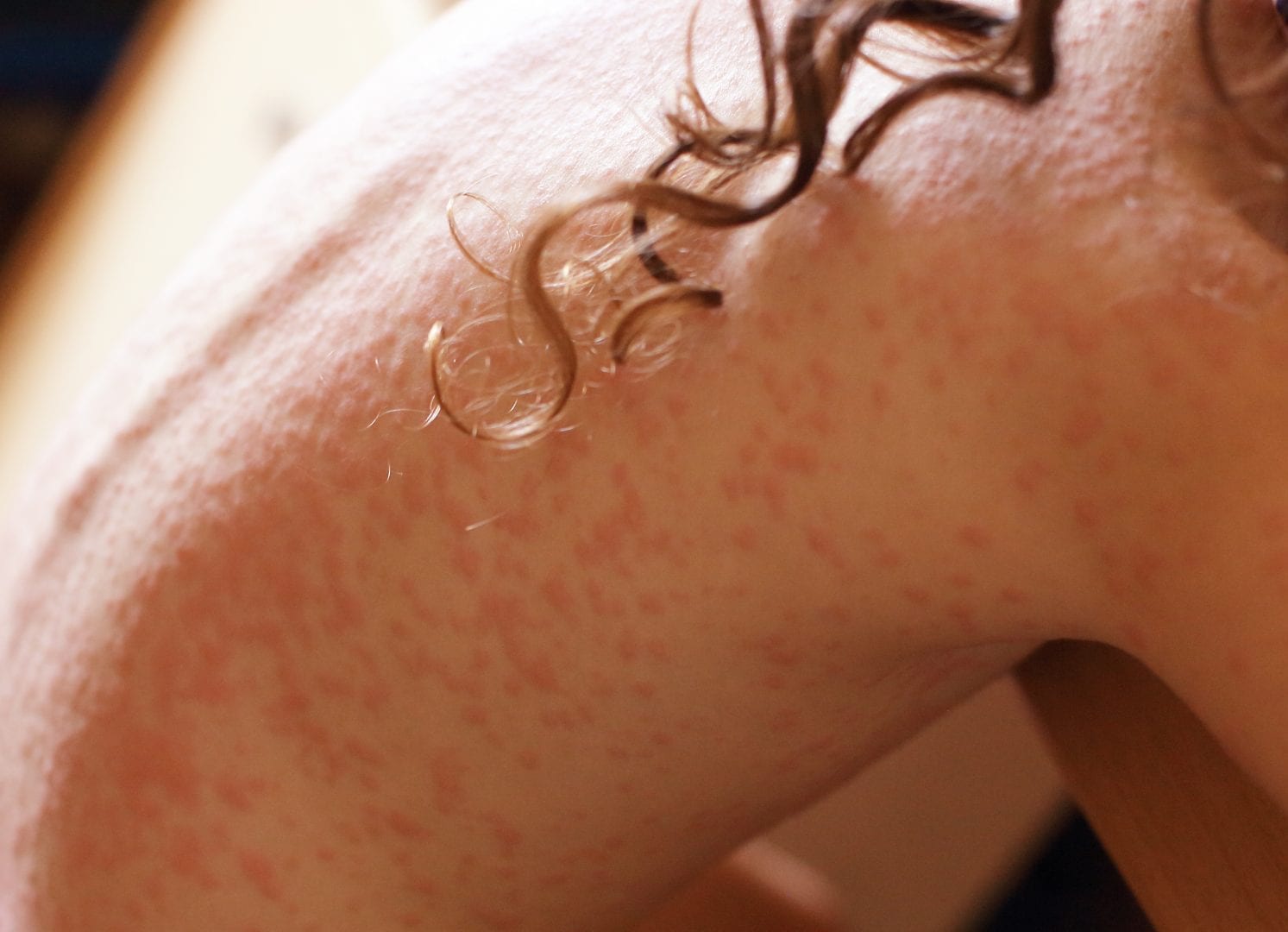 Dermatite - o que é, sintomas, tipos doença e como tratar