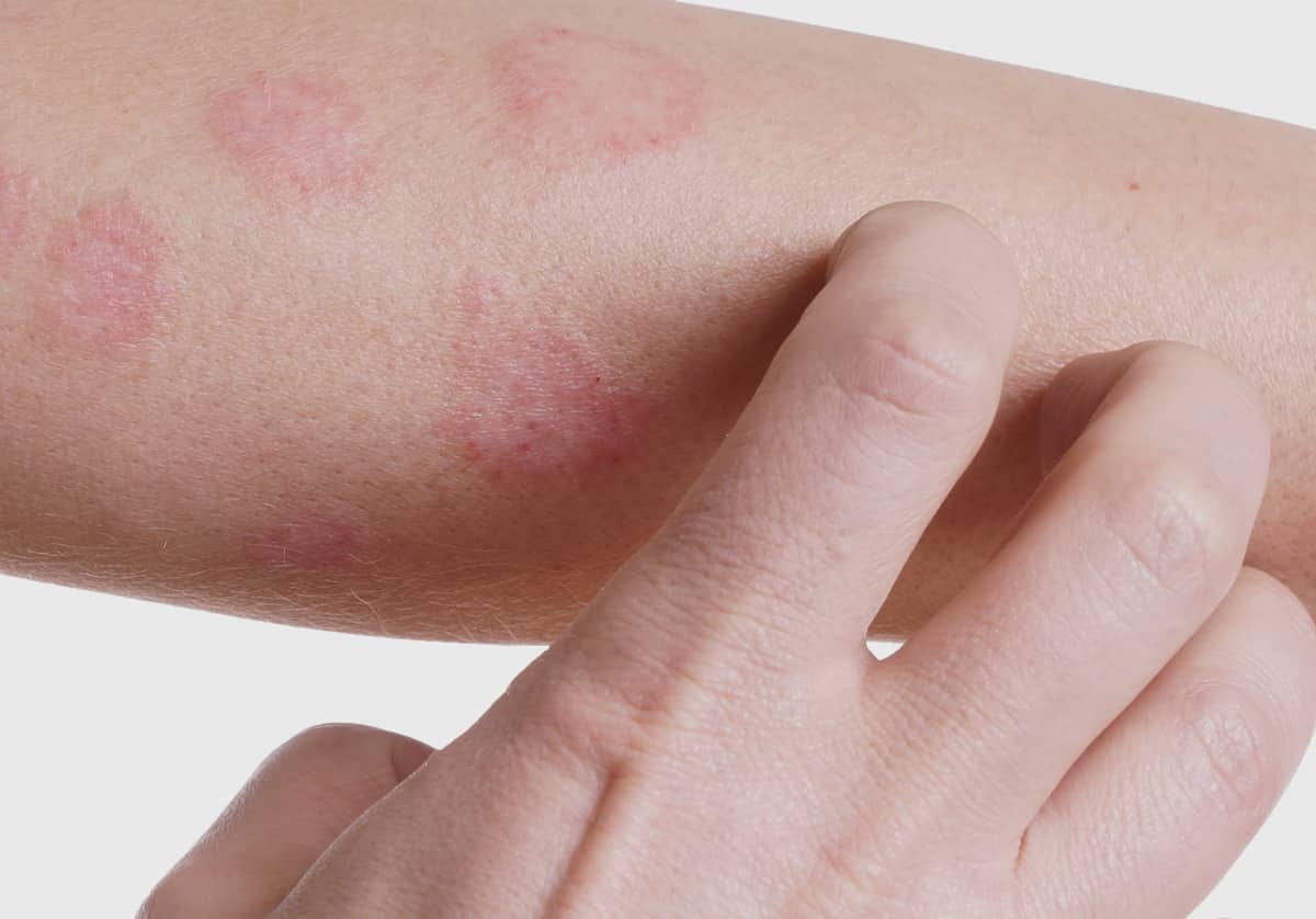 Dermatite O Que é Sintomas Tipos Da Doença E Como Tratar