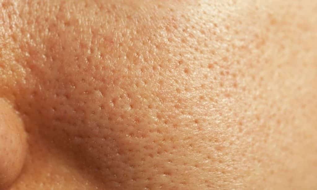 Poros dilatados: tratamentos caseiros para acabar com o problema