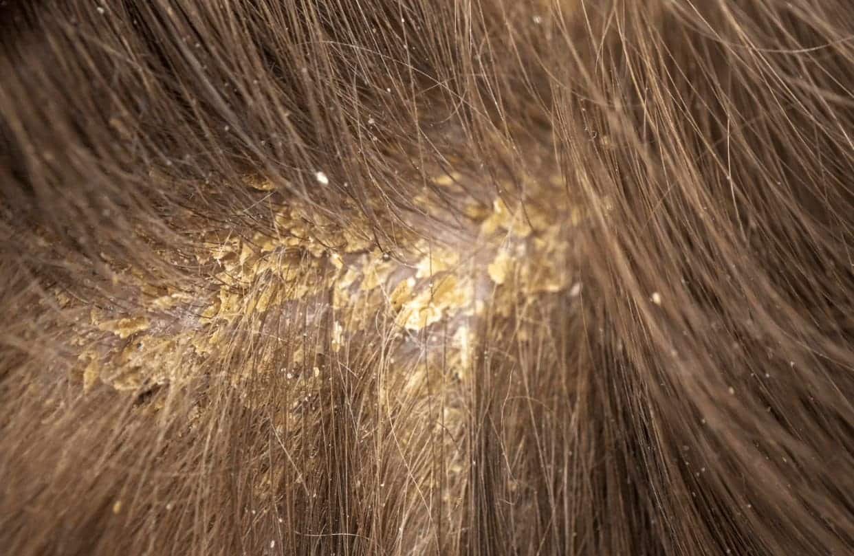 couro cabeludo com dermatite seborreica