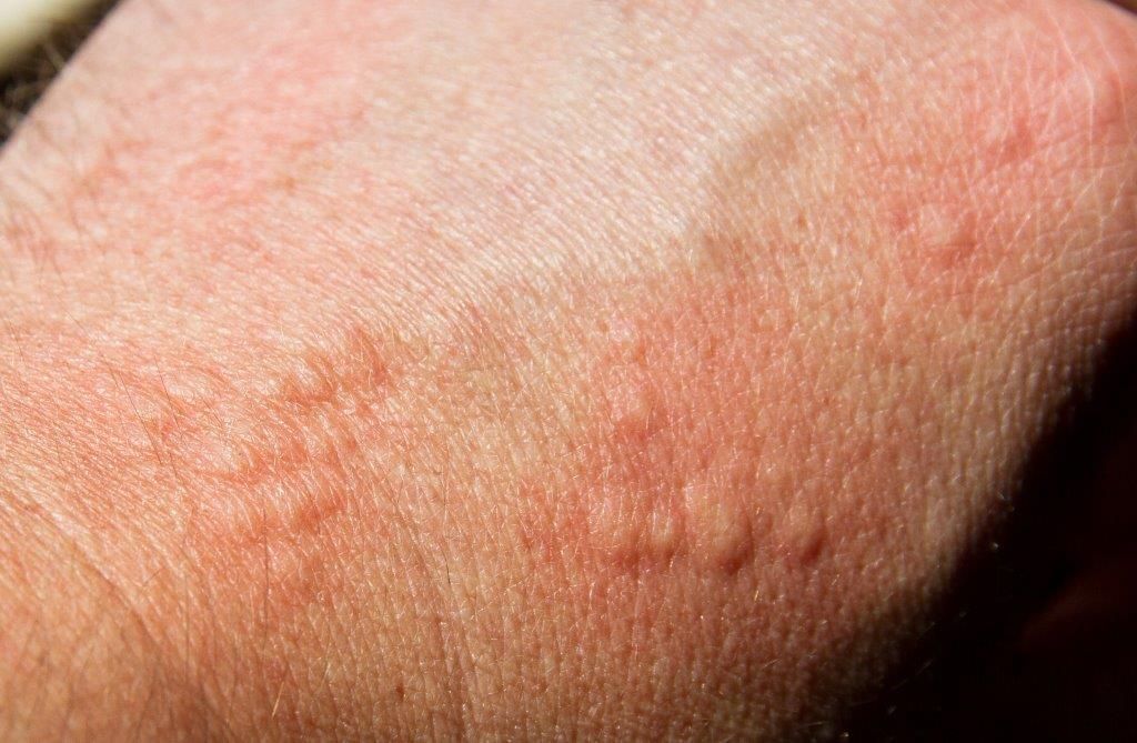 alergia ao sol sintomas causas tratamentos e prevencao 1 - Alergia al sol: síntomas, causas, tratamientos y prevención