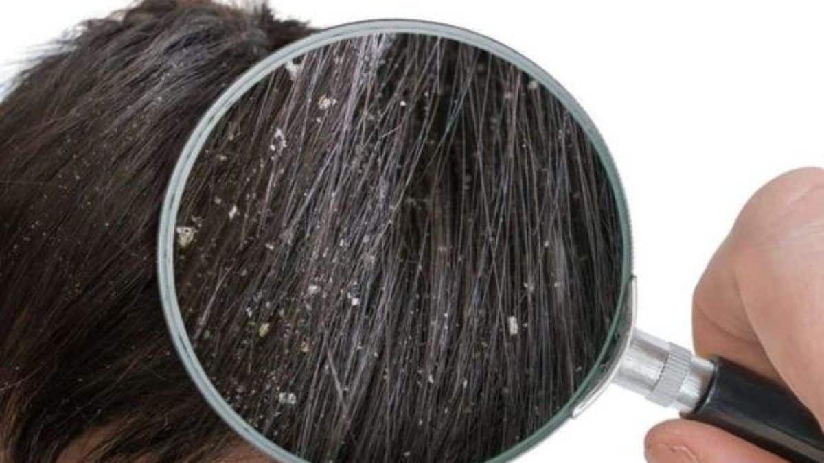 Coceira no couro cabeludo - Principais causas e como aliviar o incômodo
