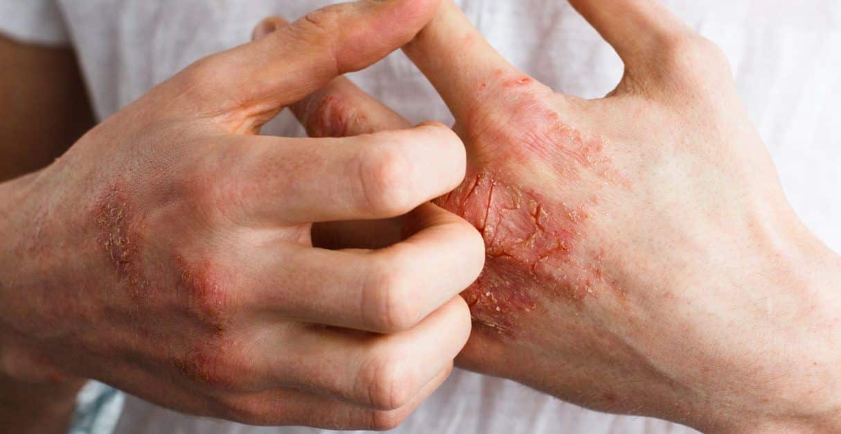mancha vermelha na pele descubra as causas 1 - Manchas rojas en la piel: principales causas del problema.