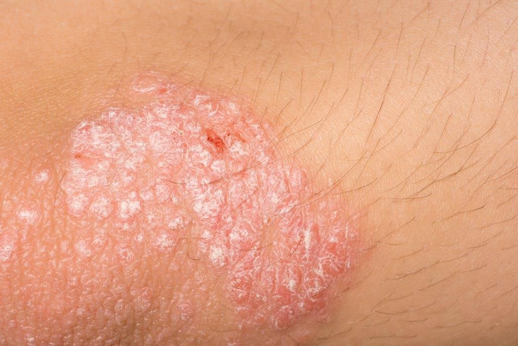 mancha vermelha na pele descubra as causas 3 - Manchas rojas en la piel: principales causas del problema.