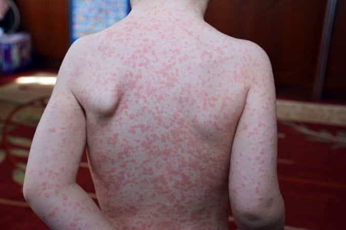 mancha vermelha na pele descubra as causas 4 - Manchas rojas en la piel: principales causas del problema.