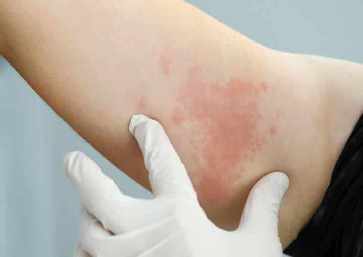 mancha vermelha na pele descubra as causas - Manchas rojas en la piel: principales causas del problema.