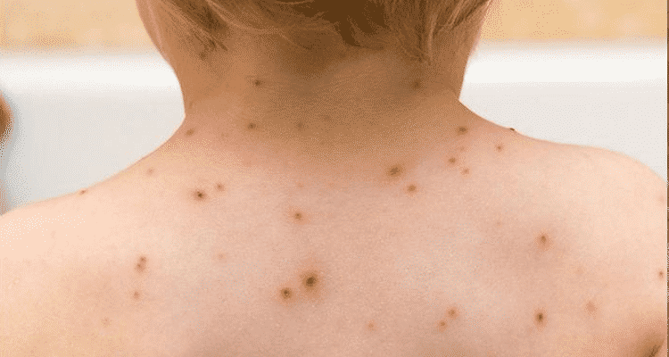 mancha vermelha na pele descubra as causas - Manchas rojas en la piel: principales causas del problema.