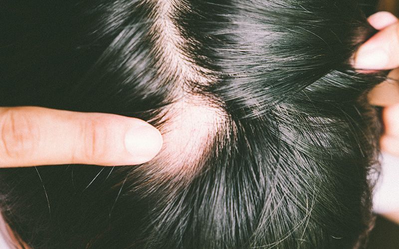 O que é alopecia? – queda de cabelo