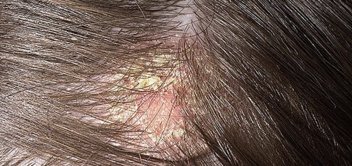 o que e alopecia causas e tratamentos para queda de cabelo 2 - ¿Qué es la alopecia?  Causas y tratamientos para la caída del cabello.