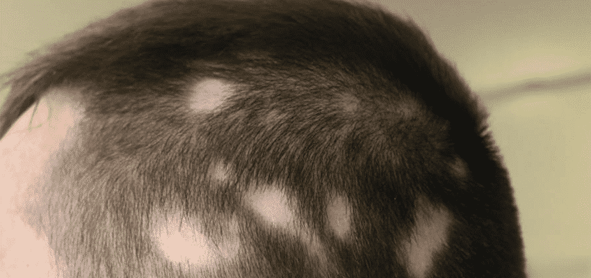 o que e alopecia causas e tratamentos para queda de cabelo - ¿Qué es la alopecia?  Causas y tratamientos para la caída del cabello.