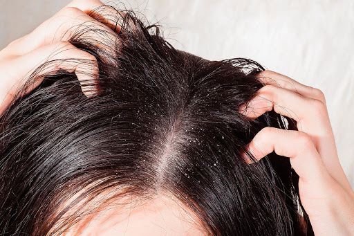 Queda de cabelo - principais causas e como evitar