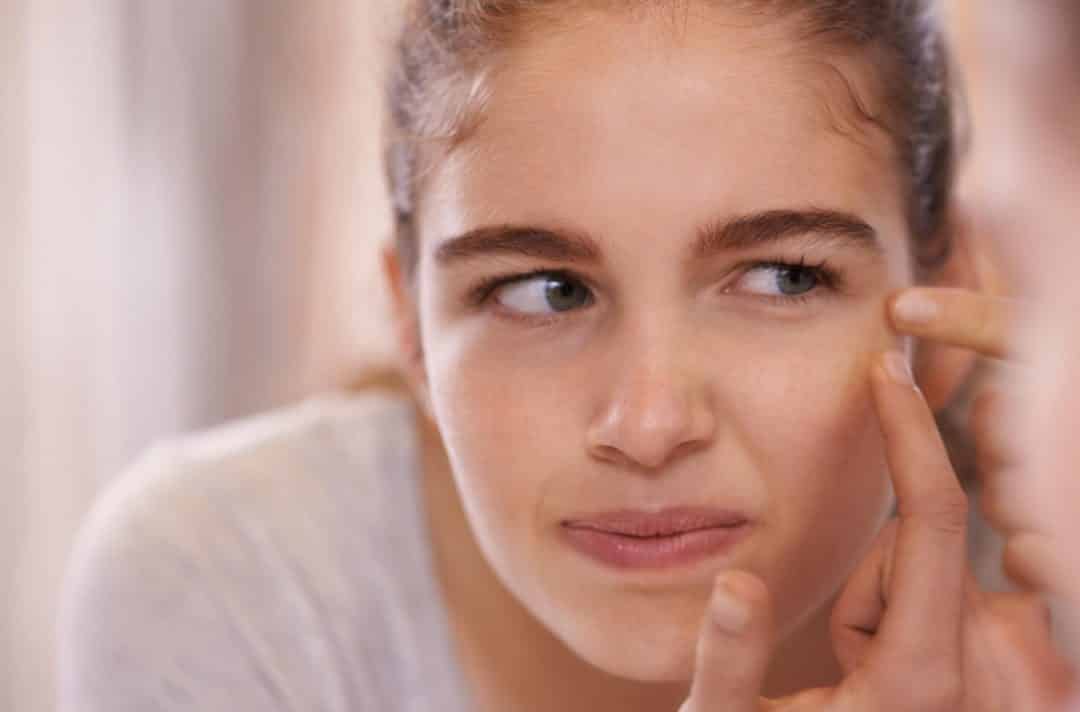 Furinhos no rosto: Dicas para prevenção e tratamentos para remoção