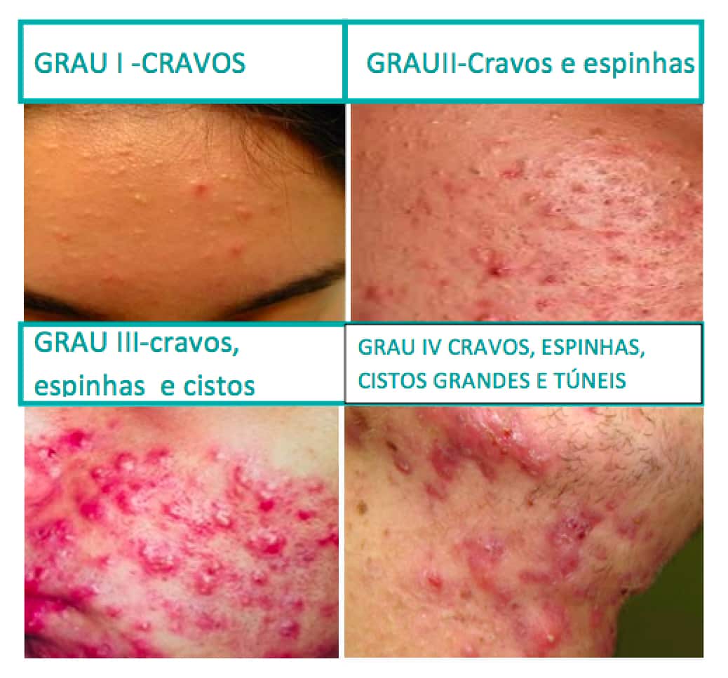 Cicatriz de acne formas de prevenir e remediar as imperfeições
