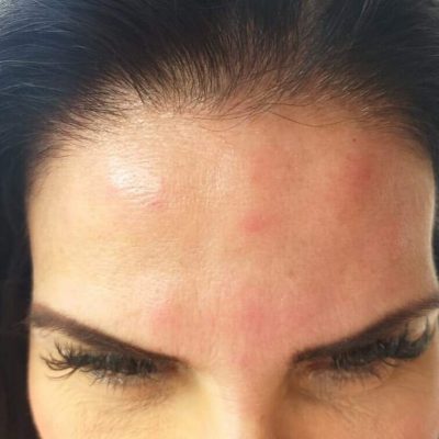 Quais os 9 Riscos do botox? Complicações que a mídia não comenta