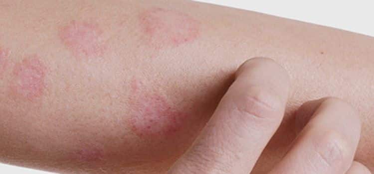 15 Doenças Que Causam Manchas Vermelhas Na Pele