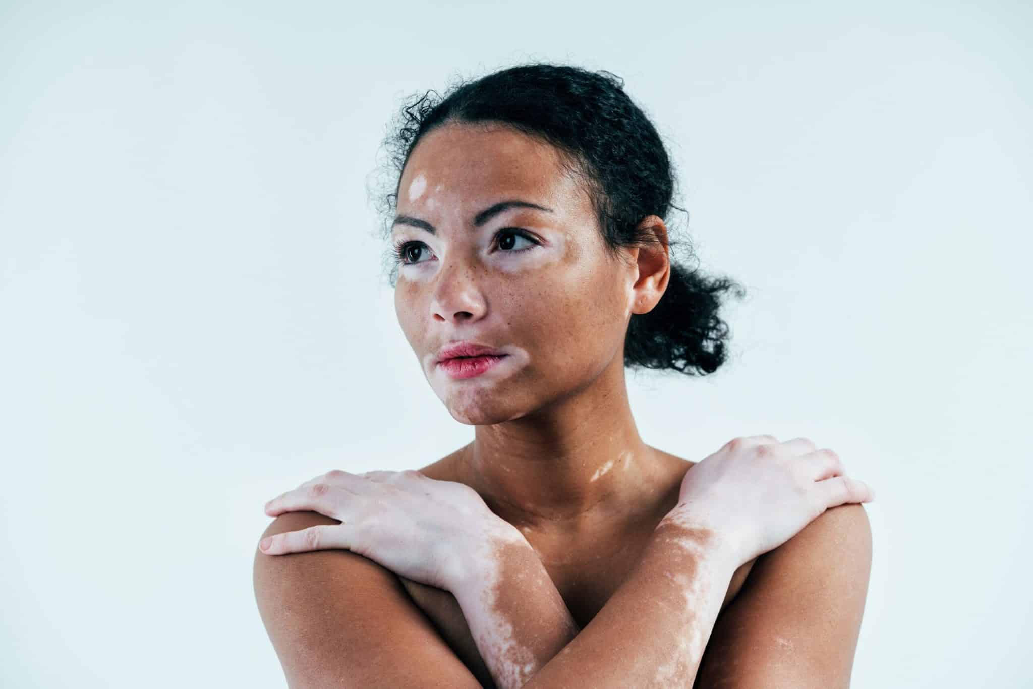 6 dicas de skincare para pele com vitiligo